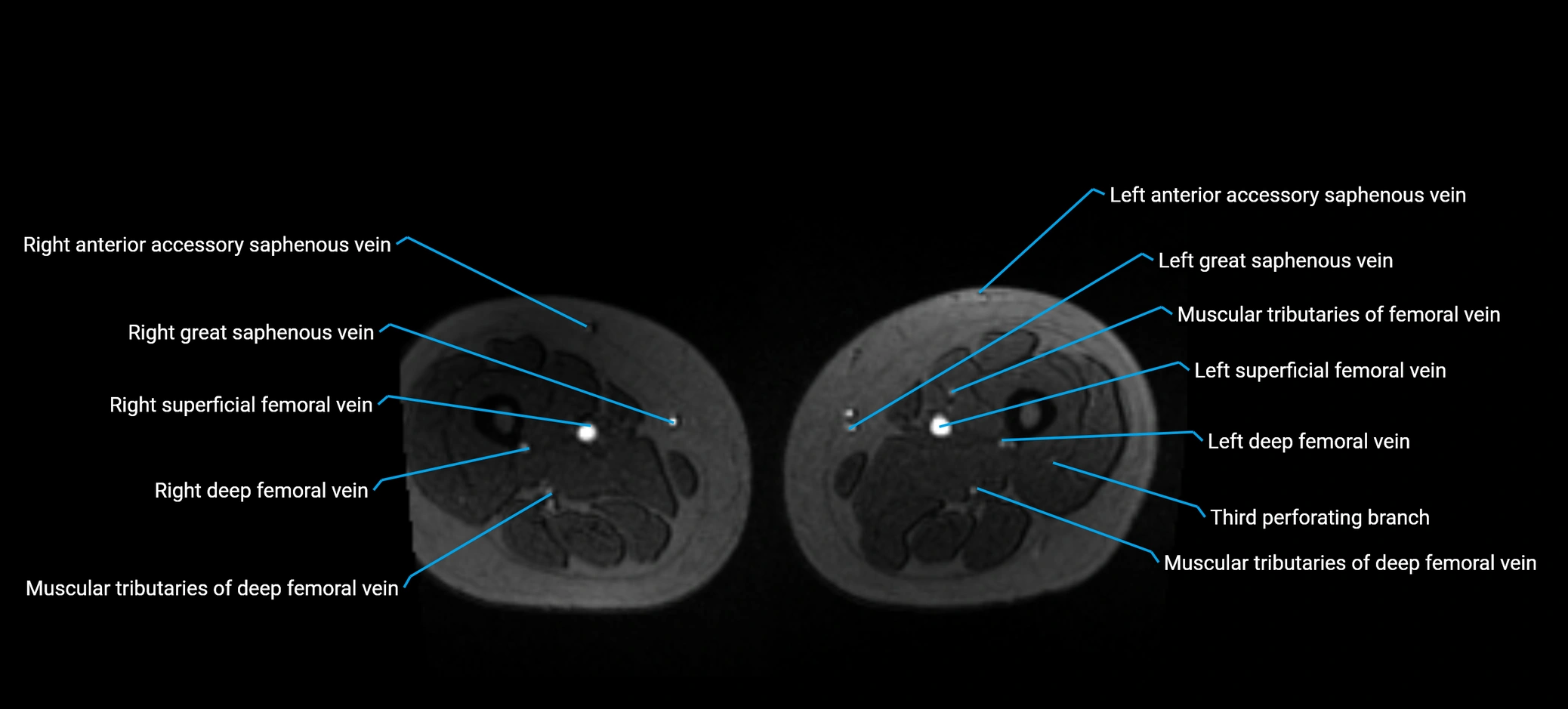 MRV abdomen pelvis & lower limb axial cross sectional anatomy labelled MRI image 276.webp